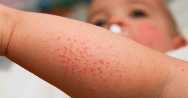 BEBEKLERDE İSİLİK